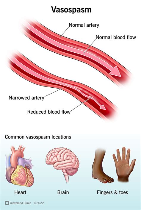 can be the result of a weakened blood vessel|Vascular Disease: Types, Symptoms, Treatment, and .